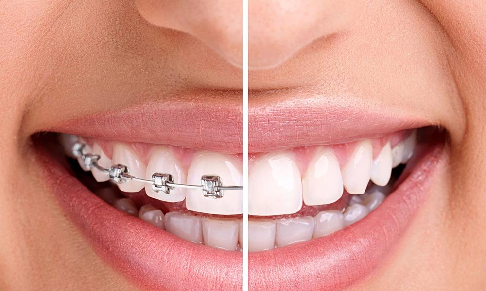 Braces before and after smile.