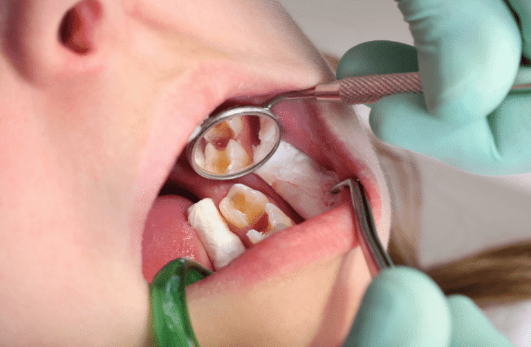 Tooth Decay