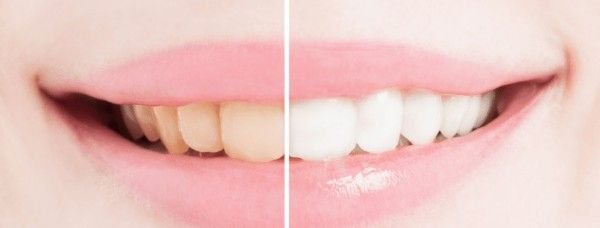 How-Long-Does-It-Take-To-Whiten-Your-Teeth-2-300x16 (1)