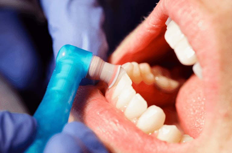What a Dental Cleaning Involves: A Step-by-Step Guide to a Healthy Smile