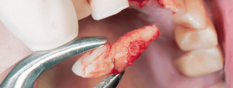 Common-Dental-Emergencies-and-First-Aid